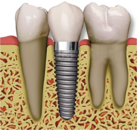 dental_implant_01-2